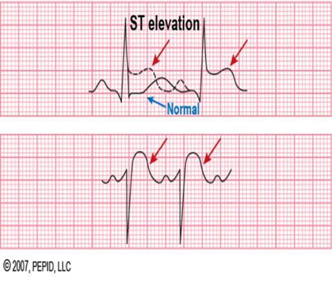 (within about 45 in the frontal pla Abnormalities of T wave T-wave inversion =
