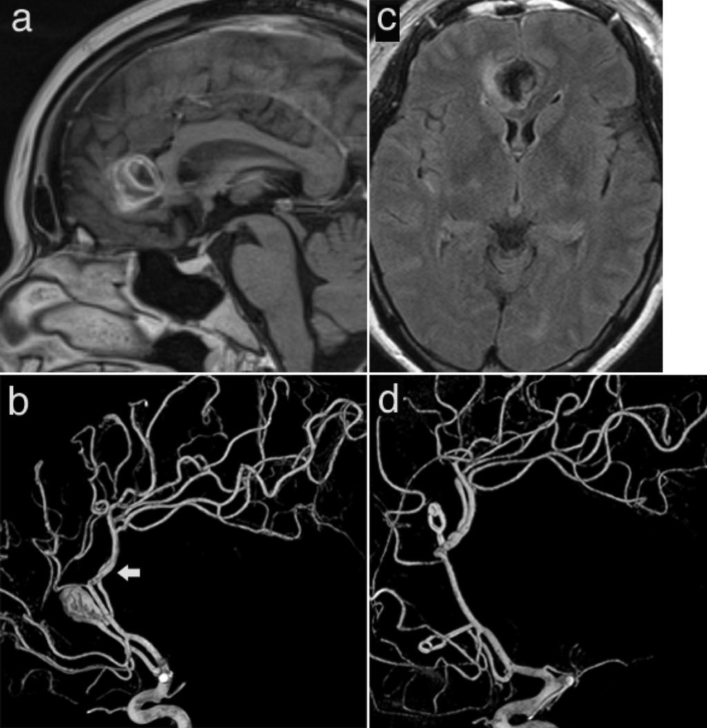 Figures Fig. 1 Fig. 1 a Preoperative sagittal contrast-enhanced T1-weighted MRI shows partially thrombosed aneurysm.