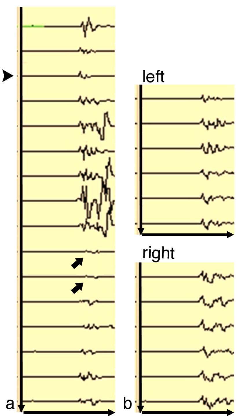Fig. 2 Fig. 2 a Motor-evoked potentials (MEP) of the abductor hallucis muscles during proximal test occlusion.