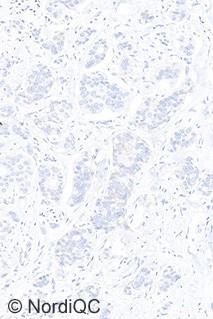 Right: Optimal staining result for HER2 of the breast ductal carcinoma no. 3 