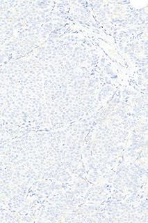 > 10% of the neoplastic cells show a weak to moderate and complete membranous staining reaction corresponding to 2+. Fig 1b.
