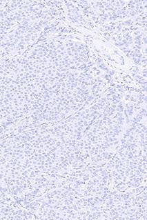 3  > 10% of the neoplastic cells show a weak to moderate and complete membranous staining reaction corresponding to 0. Fig 2b.