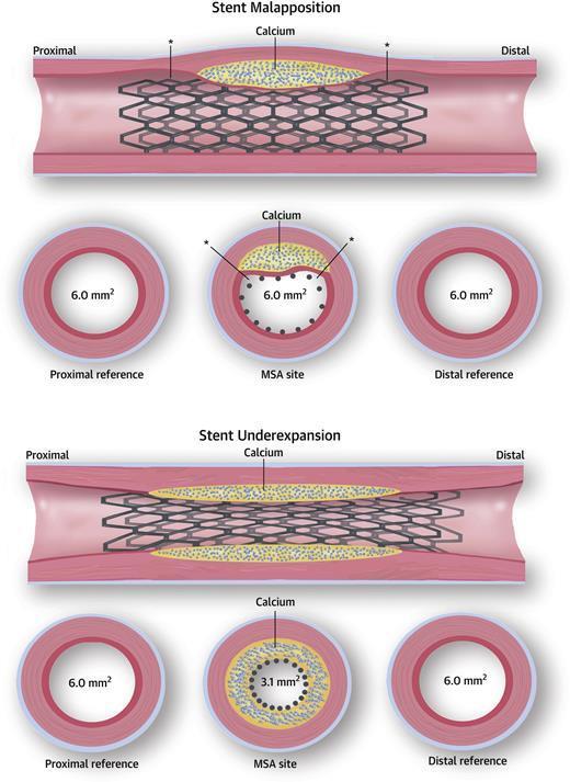 Challenges of Treating Calcified Coronary Lesions Increased Coronary Calcification Higher pressure to dilate effectively Higher number of dissections Decreased stent expansion More complications Poor