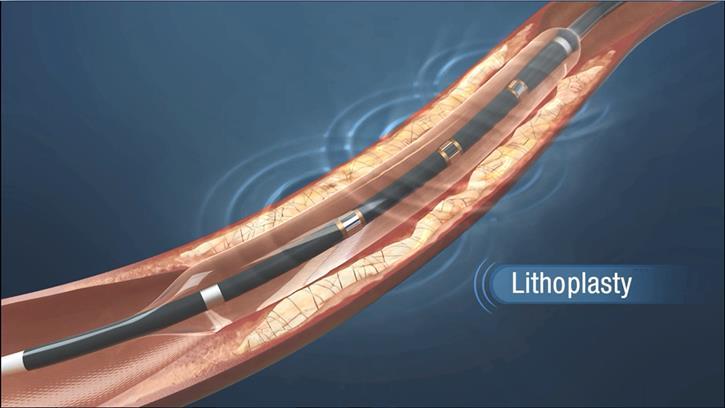 Lithoplasty Lesion modification using lithotripsy in a balloon Tissue-selective: Hard on hard tissue, Soft on soft tissue Lithotripsy waves travel outside balloon Designed to disrupt both