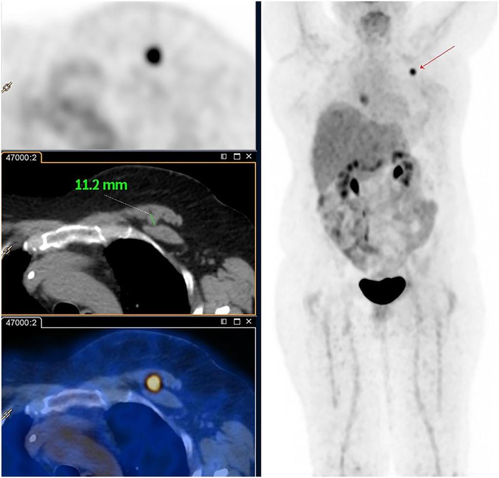 PET/CT in local recurrence (c) Copyright 2014 SNMMI; all