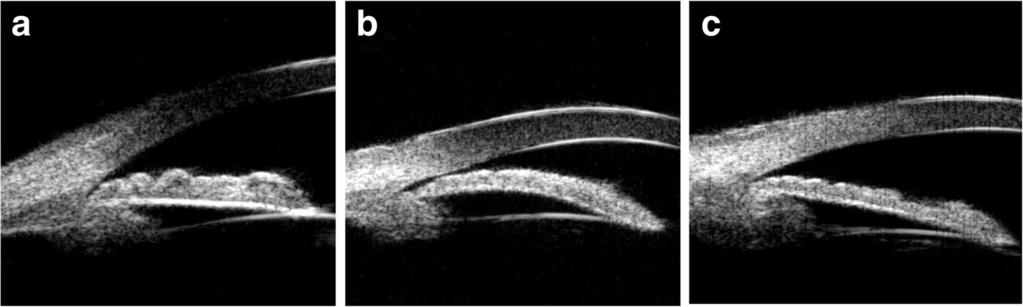 Chen et al. Trials (2017) 18:130 Page 5 of 8 Fig. 2 UBM-based angle closure configuration classification. a Thickening of the peripheral iris; b iris bombe; c anterior rotation of the ciliary body.