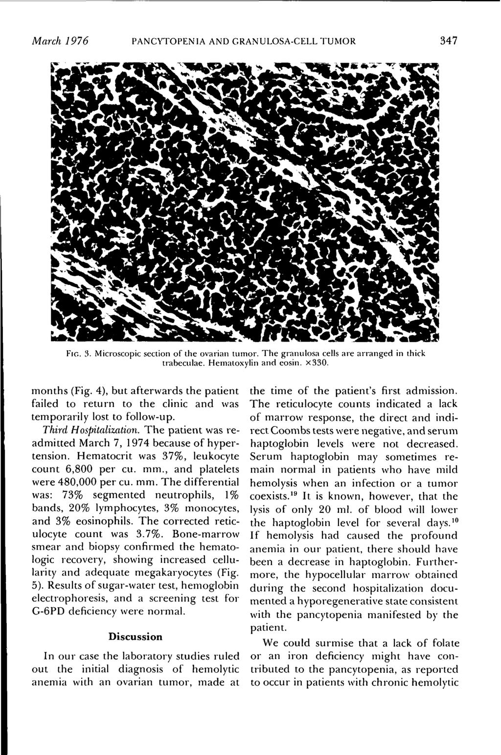 March 1976 PANCYTOPENIA AND GRANULOSA-CELL TUMOR 347 FIG. 3. Microscopic section of the ovarian tumor. The granulosa cells are arranged in thick trabeculae. Hematoxylin and eosin. x330. months (Fig.