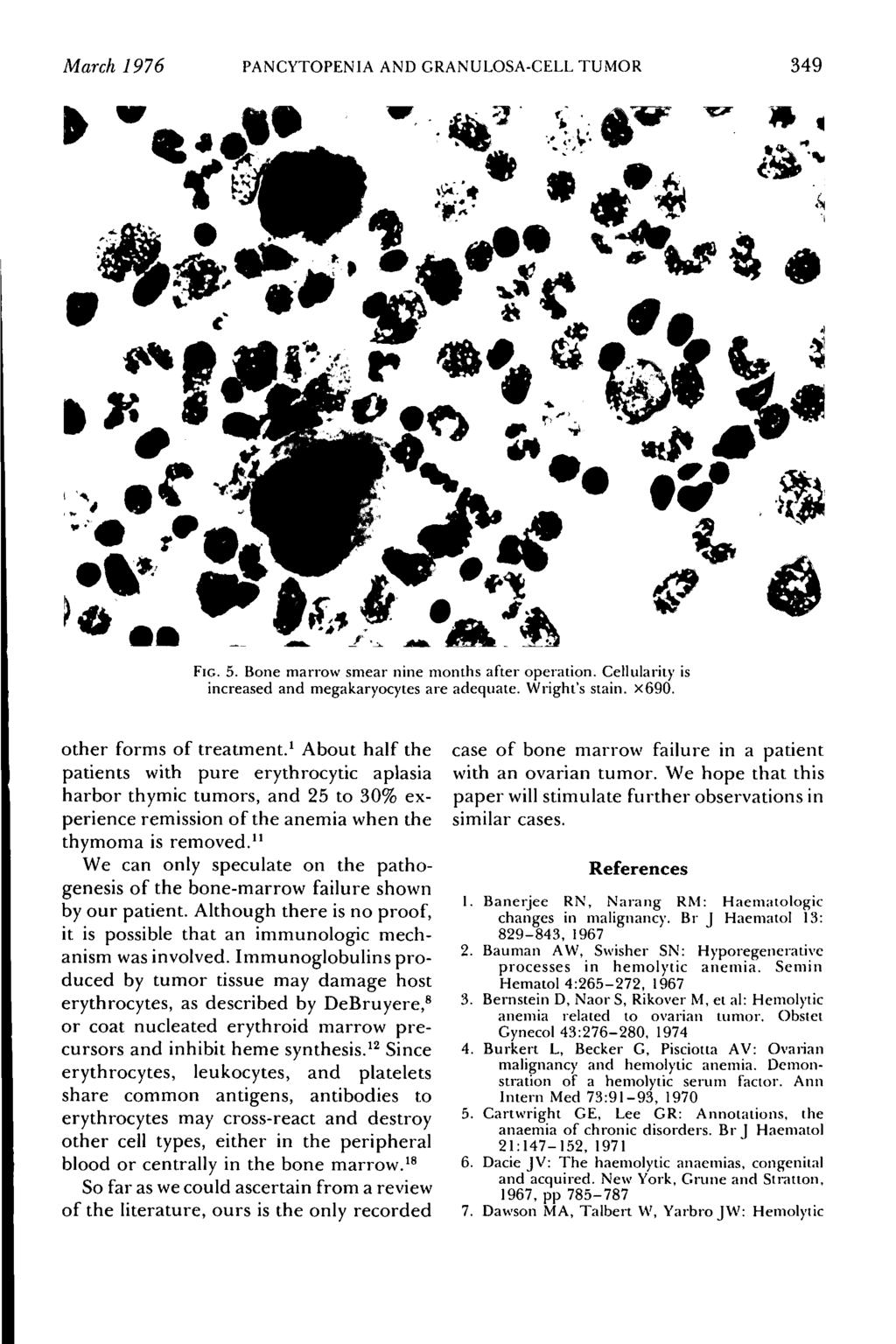 March 1976 PANCYTOPENIA AND GRANULOSA-CELL TUMOR 349 W fb FIG. 5. Bone marrow smear nine months after operation. Cellularity is increased and megakaryocytes are adequate. Wright's stain. X690.