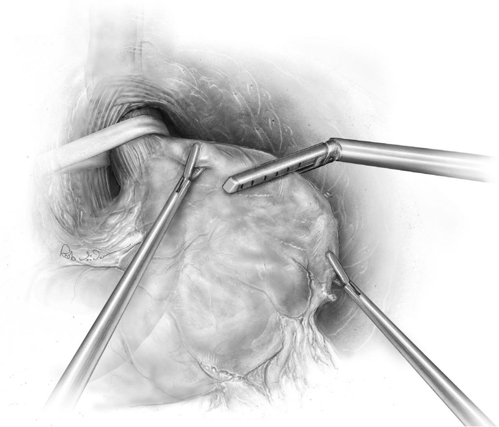 228 S.H. Teh and J.G. Hunter Figure 10 Laparoscopic staple of the fundus from greater curve toward the lesser curve. An esophageal dilator (16 mm) is placed to calibrate the width of the gastric tube.
