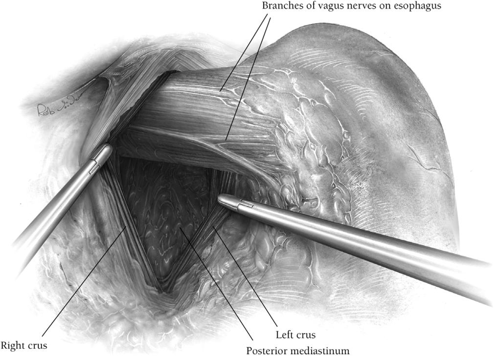 Laparoscopic Nissen fundoplication 221 Figure 3 Horizontal spreading with closed graspers to open the posterior mediastinum.