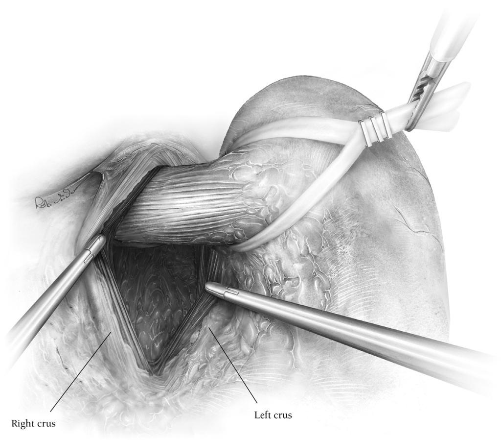 224 S.H. Teh and J.G. Hunter Figure 6 Penrose drain around the esophagus and secure with an endoloop. At the completion of the gastric dissection, the base of the left crus is reached.