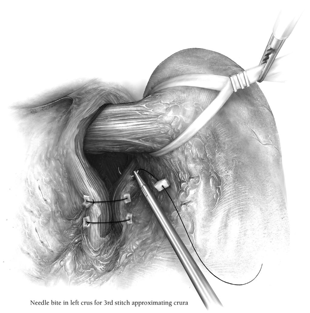 Laparoscopic Nissen fundoplication 225 Figure 7 The crural closure with nonabsorbable suture that started posteriorly and working anteriorly.