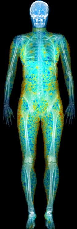 The patient s bone, lean and fat attributes are where densities, weight and area can be monitored regionally.