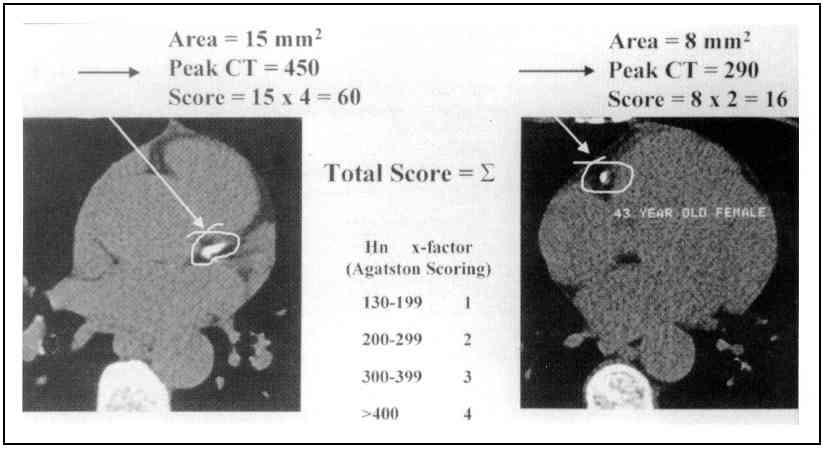 Coronary Artery Calcium Scoring For image on left (LAD), calcium score is 60. For image on right (RCA), calcium score is 16.