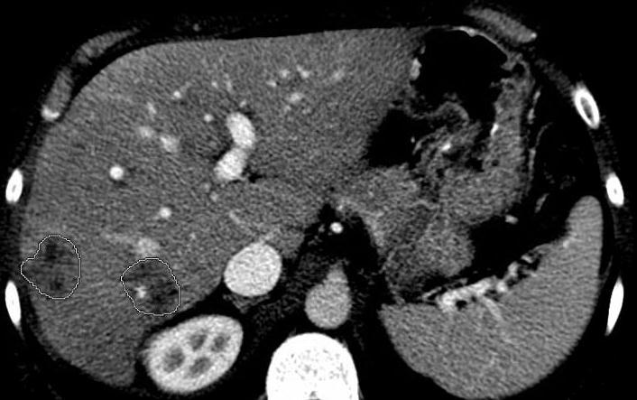 Case #2: TIL from 4 non-contiguous liver metastases 48 year old woman with stage IV colon