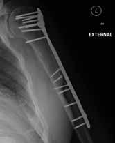 tissues, particularly the rotator cuff tendons to augment bony fixation (up to a 2.
