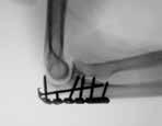 provisional wire fixation or triceps augmentation of fixation with sutures