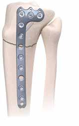3.5mm Lateral Proximal Tibia Locking Plate Plate selection Following fracture reduction, select the Lateral Proximal Tibia Locking Plate that best accommodates patient anatomy and fracture pattern.