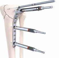 Tap (optional) In areas of increased bone density, it may be beneficial to tap prior to screw insertion. Tap by using the 4.0mm Cancellous Tap (7117-3386).