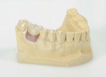 6 Temporary restorations Until the definitive superstructure has been made, the implants can be restored with temporary crowns and bridges. There are two possible options: 6.