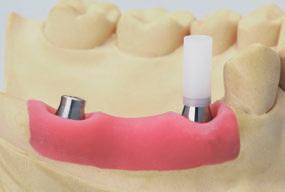 1 Step 1 Position the selected Gold Coping or Plastic Coping, then secure with an SCS Occlusal Screw or SCS Guide Screw.