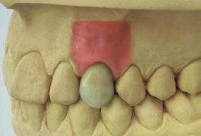 For reasons of hygiene, the cement margin must lie no deeper than 2.0 mm below the gingiva.