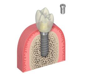 Tighten the superstructure on the synocta 1.5 Abutment with a torque of 15 Ncm. The following options are available for securing the superstructure: SCS Occlusal Screw Art. No. 048.