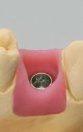 676 1a 1b A-1) Fabricating a transocclusal screw-retained single crown Step 1 Align the abutment on the working model and hand-tighten the abutment screw using the