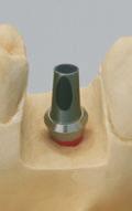 1 A-2) Fabricating a cemented single crown Step 1 In this case, the