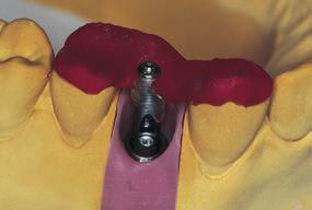 610/611/615/616 It can be placed on the RN synocta Angled Abutment and secured with
