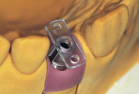 C) Transfer Aid To ensure correct transfer of the position of the RN synocta Transversal (TS) Abutment