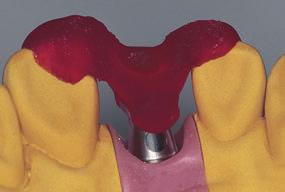003V4 It is made from polymerizable plastic and is placed on the RN synocta Transversal (TS) Abutment.