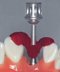 Remove the RN synocta Transversal (TS) Abutment from the master cast