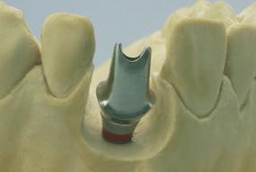 Note: If you choose to veneer directly onto the RN synocta Gold Abutment, you have to ensure that you have a sufficient metal thickness of the dental casting