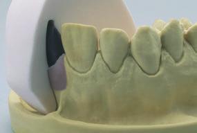 the customized abutment.