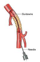 The specialist will then usually discuss the map of your arteries with you, and go through the pros and cons of proceeding with treatment to open up the blocked or