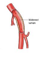 After the angiogram, a wire is inserted into the artery, usually at the same point as the angiogram has been taken.
