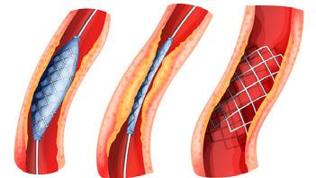 What is a stent? A stent is a hollow mesh tube about the size of your little finger. It is made of fine sterile metal and is used to hold open an artery.