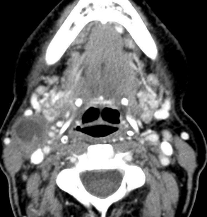 NIRADS 2 Neck NIRADS 2 neck imaging findings: Questionable nodal recurrence or residual nodal disease with mild or intermediate FDG uptake Neck: 2 Recommend PET 2 mo post treatment Enlarged right