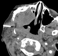 uptake CT guided biopsy No malignant cells in