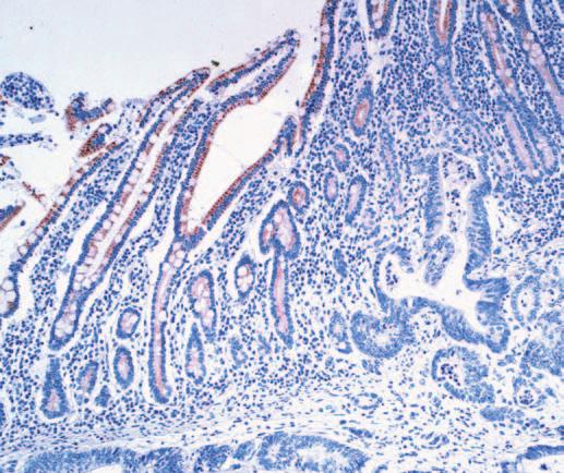 The staining was diffuse in 18 cases (75%) and focal in 6.