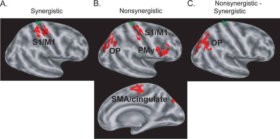 Figure 3. Functional MRI results showing differences in cortical activation in chronic stroke patients compared with normal control subjects during performance of the hand motor tasks.