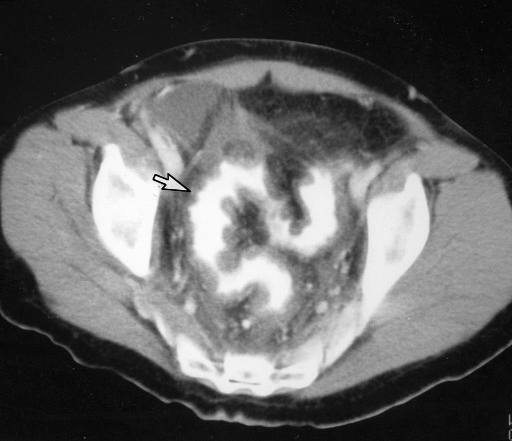 CT Diagnosis of Clostridium difficile Colitis A B Fig. 2. 32-year-old man with abdominal pain, fever, elevated WBC count, and diarrhea. Stool assay was positive for Clostridium difficile toxin.