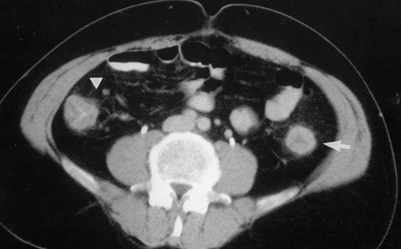 Kirkpatrick and Greenberg Fig. 3. 55-year-old man with bloody diarrhea and abdominal pain. Stool assay was negative for Clostridium difficile toxin.