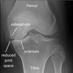 Typical presentations (Continued) Meniscal injury o Male or female o Twisting injury with physical activity.