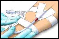 Establishing a BH Track cont d 9. Securely tape the AV fistula needle. 10.
