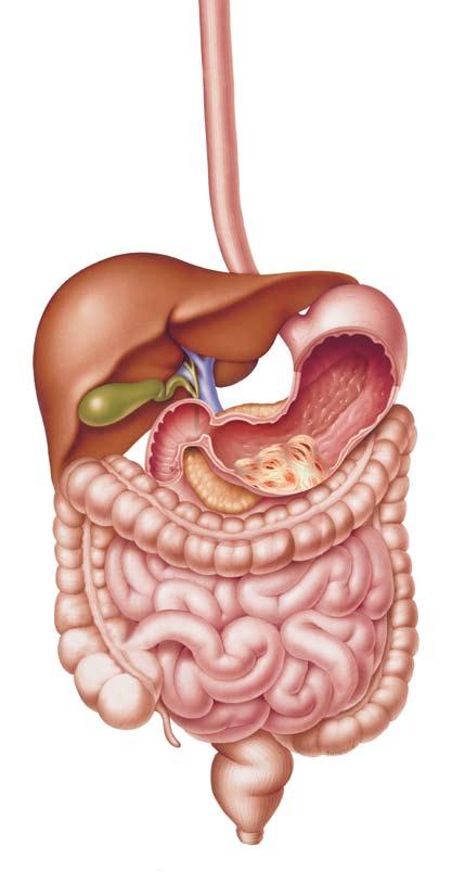 GIST Digestive Tract Esophagus Liver* Stomach Large intestine (colon) Example of GIST Small intestine Rectum *The liver is not part of the digestive tract, but it is the most common