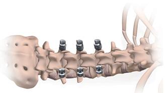 Turn the handle clockwise until the pedicle screw is properly placed to the desired depth.