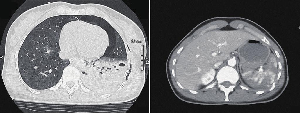 Journal of Thoracic Disease, Vol 8, No 7 July 2016 A 1827 B Figure 2 Thoraco-abdominal CT scan demonstrating an expanding left lung hematoma (A) and splenic lacerations (B). CT, computed tomography.