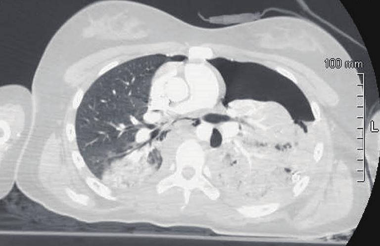 CT scan revealed an AAST grade 4 spleen laceration with hemoperitoneum and left hemo-pneumothorax associated with left lung hematoma (ISS =26) (Figure 2).